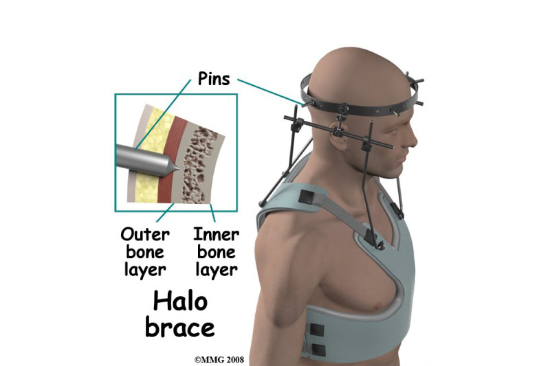 Bremer Halo Kragen